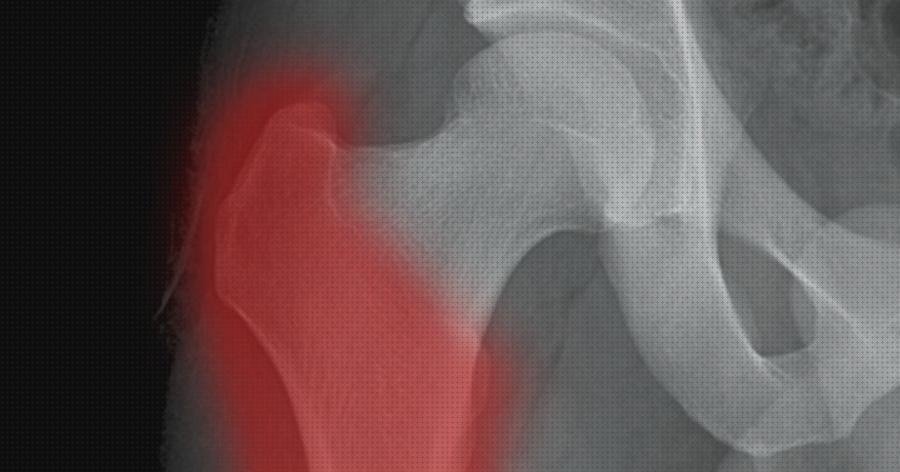 Las mejores 10 Ecografías Diagnostico Trocanteritis