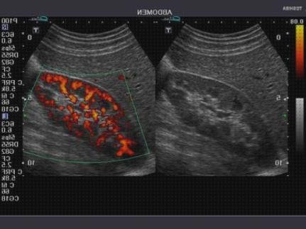¿Dónde poder comprar riñones doppler ecografía doppler de riñones?