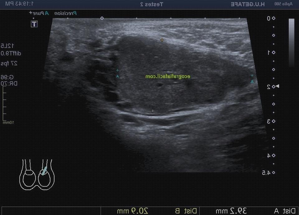 Las mejores ecografía doppler paraganglioma