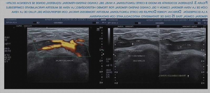 Review de ecografía doppler trombos piernas