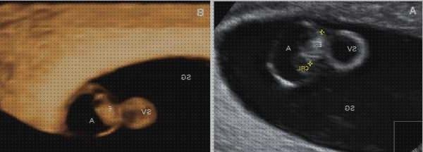 Las mejores marcas de Mas ecografía segundo trimestre embarazo Mas ecografía cabeza grande Mas ecografía coneja ecografía e e 6
