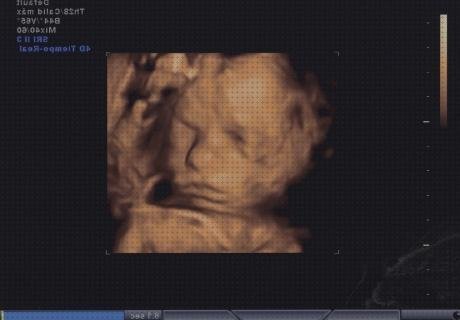 Las mejores Mas ecografía segundo trimestre embarazo Mas ecografía cabeza grande Mas ecografía coneja ecografía e e 6