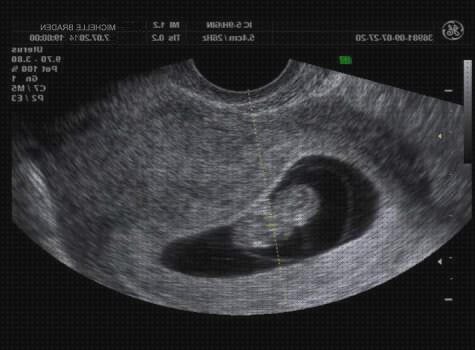 ¿Dónde poder comprar semanas ecografía embarazada de 8 semanas?