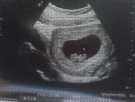 Las mejores semanas ecografía embarazada de 8 semanas