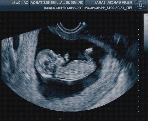 Las mejores marcas de ecografía 3 semanas embarazo ecografía once semanas ecografía embarazo 10 semanas