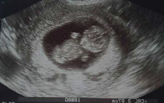 Review de ecografía embarazo 10 semanas