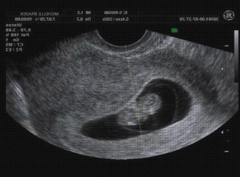 Las mejores marcas de ecografía once semanas ecografía en color 8 semanas de embarazo