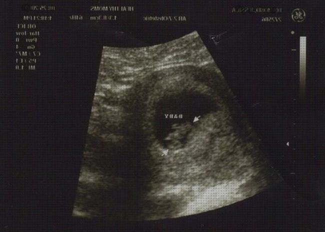 Las mejores meses ecografía feto tres meses