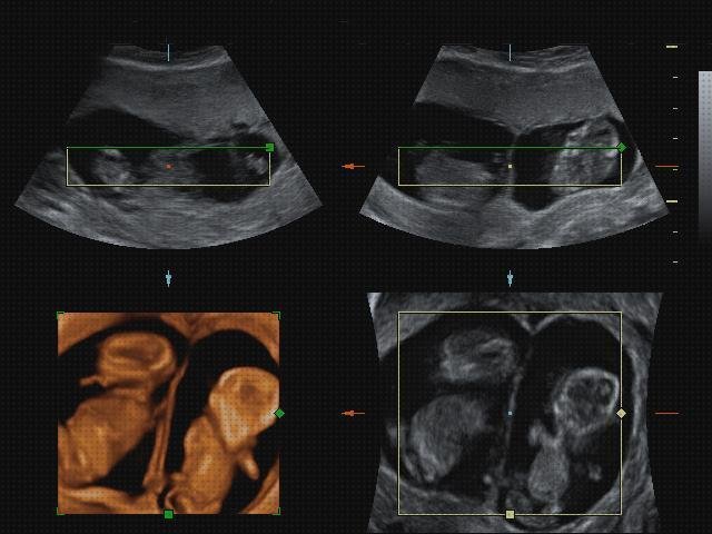 Opiniones de las 18 mejores Ecografías Gemelar 3 Meses