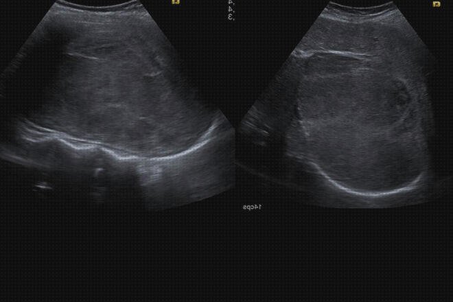 ¿Dónde poder comprar tensiometro niños ecografía hepática en niños?