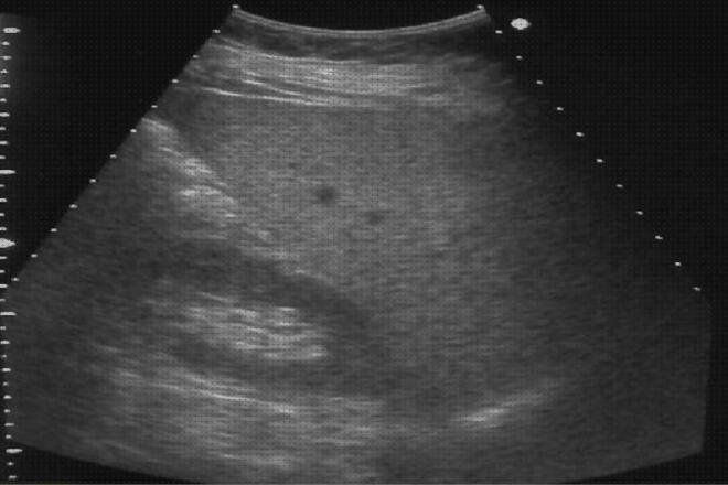 Review de ecografía hepática en niños