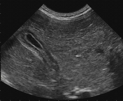 Opiniones de tensiometro niños ecografía hepática en niños