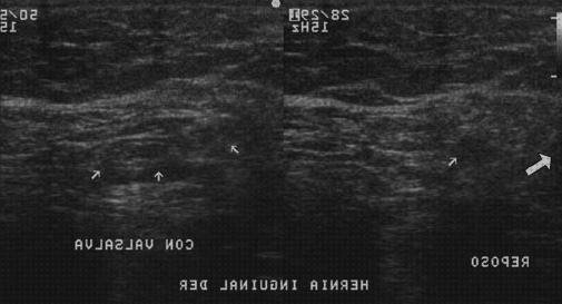 Review de ecografía hernia femoral