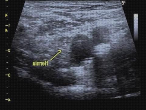 Opiniones de las 4 mejores Ecografías Hernias Femorales