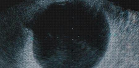 Opiniones de las 12 mejores Ecografías Líquidos Foliculares En Pelvis