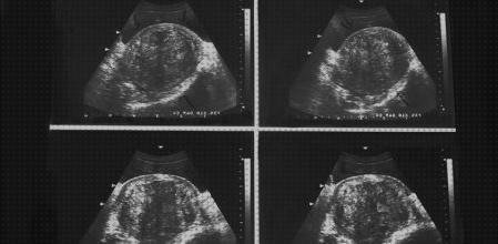 Análisis de las 6 mejores Ecografías Miomas Menstruaciones