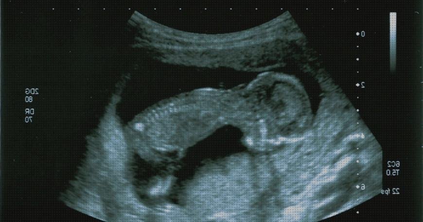 ¿Dónde poder comprar ecografía once semanas ecografía morfológica 20 semanas?