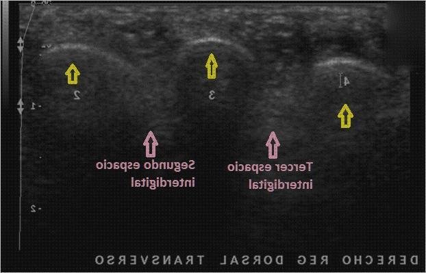 ¿Dónde poder comprar ecografía neuroma de morton?