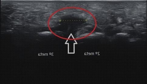 Las mejores marcas de ecografía neuroma de morton