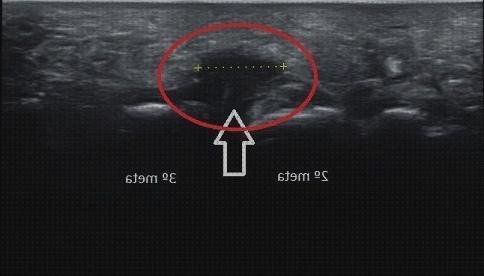 Las mejores ecografía neuroma de morton