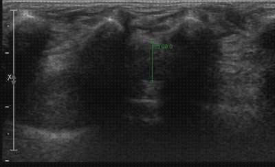 Análisis de las 9 mejores Ecografías Neuroma De Morton