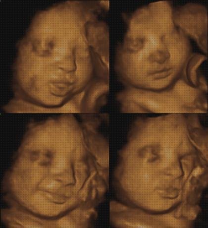 Análisis de las 8 mejores Ecografías Para Niños Con Sindrome De Down