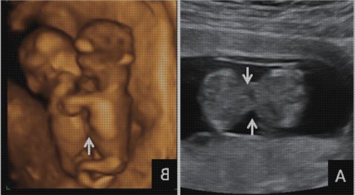 Review de ecografía obstétrica doppler 12 semanas
