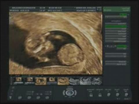 Las 9 Mejores Ecografías Obstétrica Doppler 12 Semanas