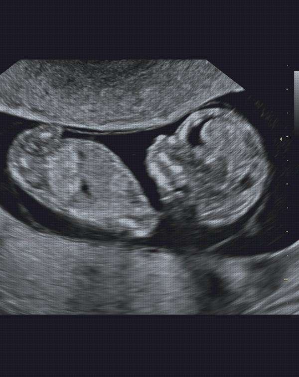 Las mejores trimestres ecografía obstétrica por trimestres