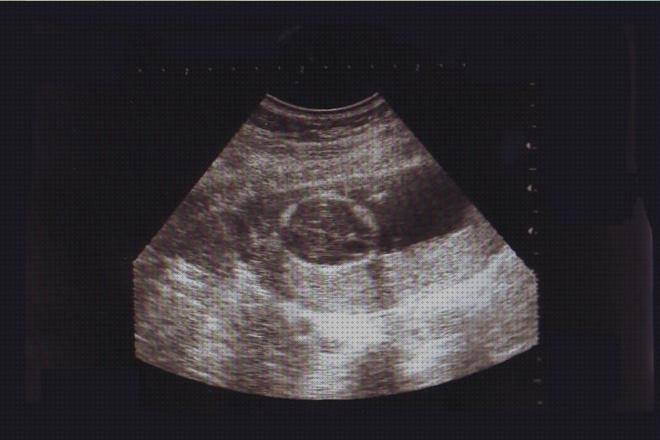 Review de ecografía obstétrica por trimestres