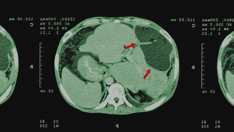 ¿Dónde poder comprar higado ecografía para ver cancer higado sin contraste?