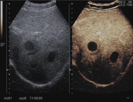 Las mejores 9 Ecografías Para Ver Cancer Higado Sin Contrastes