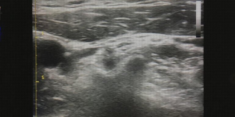 Opiniones de las 6 mejores Ecografías Plexos Cervicales