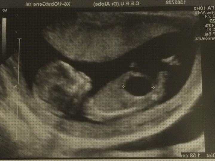 ¿Dónde poder comprar prenatal ecografía prenatal vejiga?