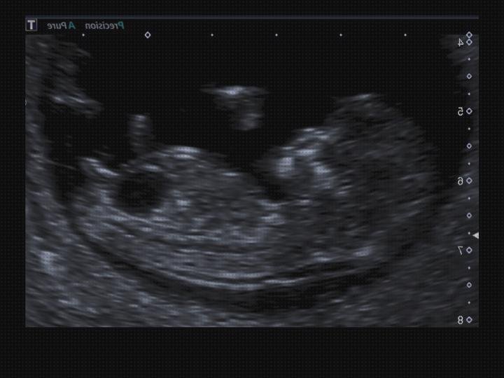 Review de ecografía prenatal vejiga