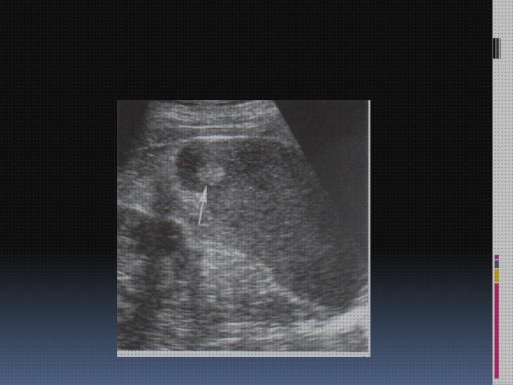 Opiniones de prenatal ecografía prenatal vejiga