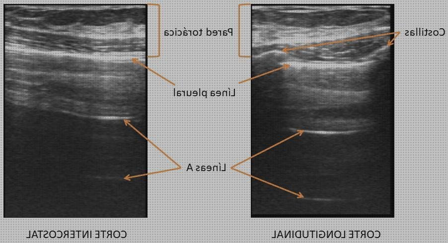 ¿Dónde poder comprar pulmones ecografía pulmones sanos?