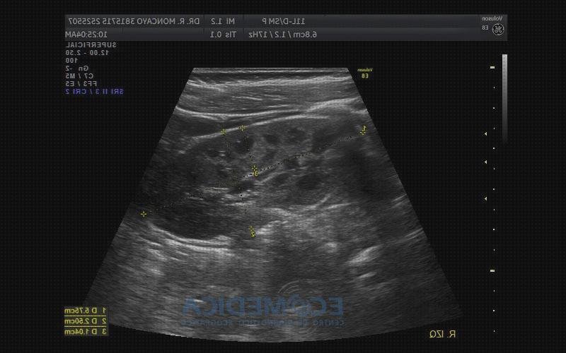 Review de ecografía renal completa