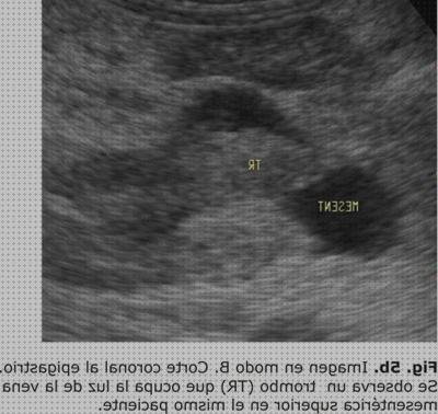 Review de ecografía renal duplex color