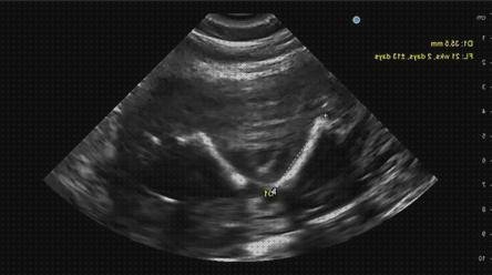 Las mejores 9 Ecografías Segundos Trimestres Biometria Fetal