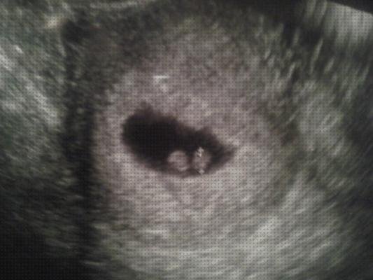 Las mejores marcas de ecografía once semanas ecografía sin latidos 10 semanas