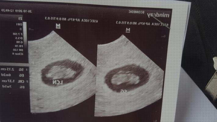 Análisis de las 9 mejores Ecografías Sin Latidos 10 Semanas