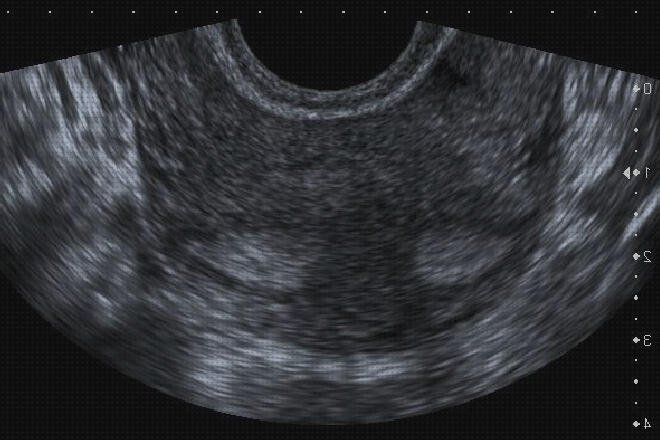 Las 6 Mejores Ecografías Transvaginal Tvus