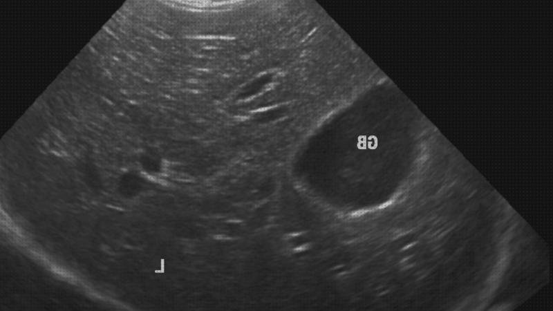 ¿Dónde poder comprar higado ecografía tumor higado?