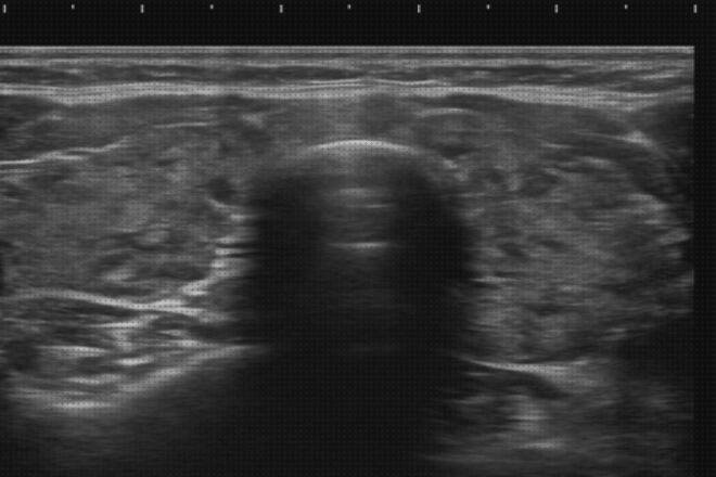 Las 12 Mejores Ecografías Ultrasonidos Cancer De Tiroides