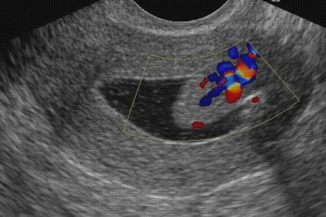 Las mejores 16 Ecografias Utero Anatomia Ecografica Carcinomas Cervicales