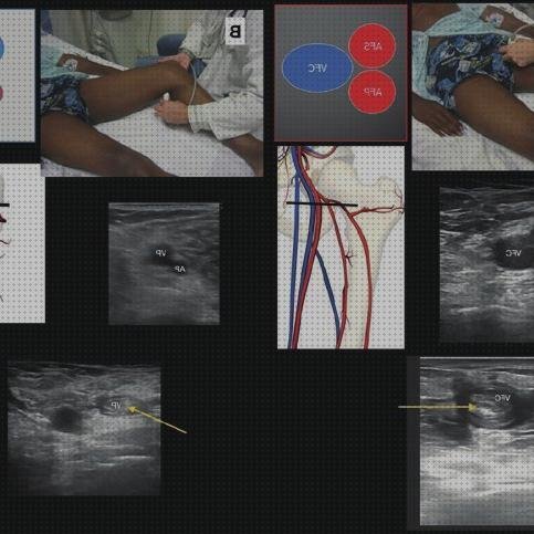 Las mejores ecografía yugular ecografías ecografía vena femoral