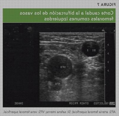 Review de ecografía vena femoral