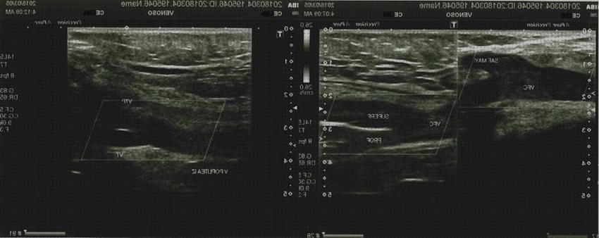 Opiniones de ecografía yugular ecografías ecografía vena femoral