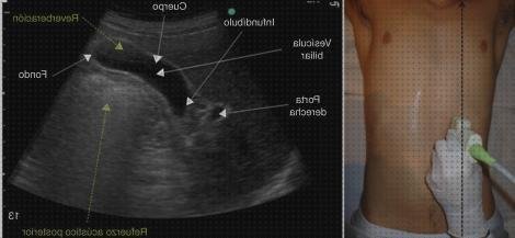 Las mejores ecografía y hernia hiatal